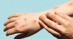 Santa Cruz registra dos casos positivos y cuatro sospechosos de viruela del mono