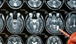 Un popular anticonceptivo de Pfizer incrementa el riesgo de desarrollar tumores cerebrales